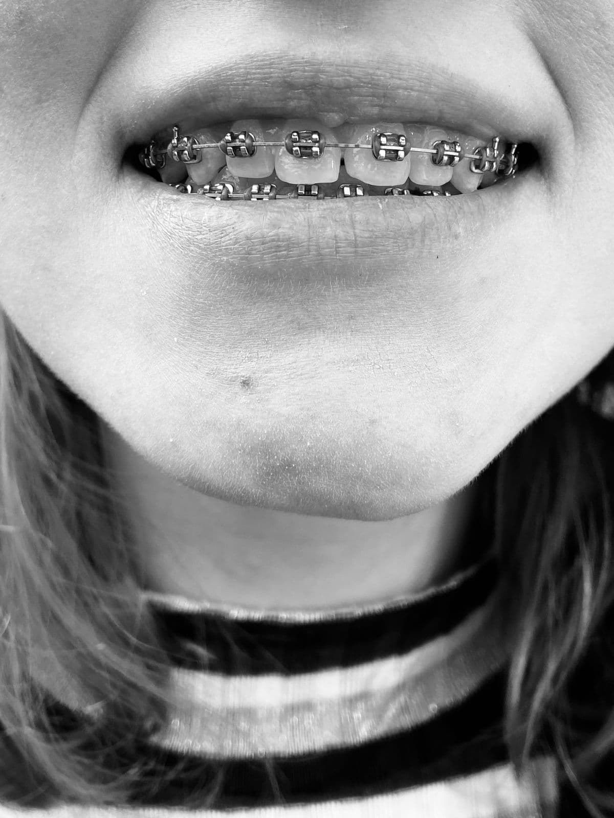 A striking black and white close up of a smile with metal braces